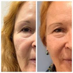 20245 04 14 Qué es una armonización facial (3)